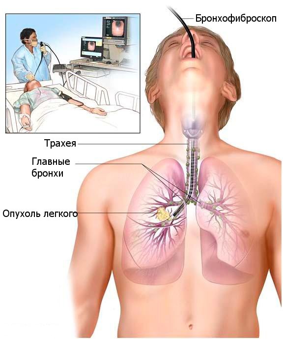 Лечение и симптомы рака легких 4 стадии Лечение и симптомы рака легких 4 стадии