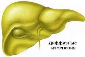Песок в желчном пузыре - симптомы и лечение Песок в желчном пузыре - симптомы и лечение