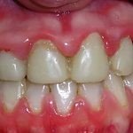 Плохой запах изо рта Плохой запах изо рта