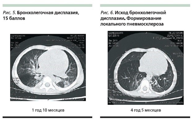 Пневмофиброз: особенности течения и терапии Пневмофиброз: особенности течения и терапии