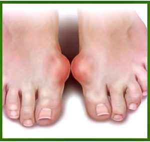 Подагрический артрит: симптомы и лечение острой формы при подагре Подагрический артрит: симптомы и лечение острой формы при подагре