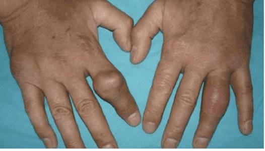 Подагра у женщин: симптомы, лечение и фото Подагра у женщин: симптомы, лечение и фото