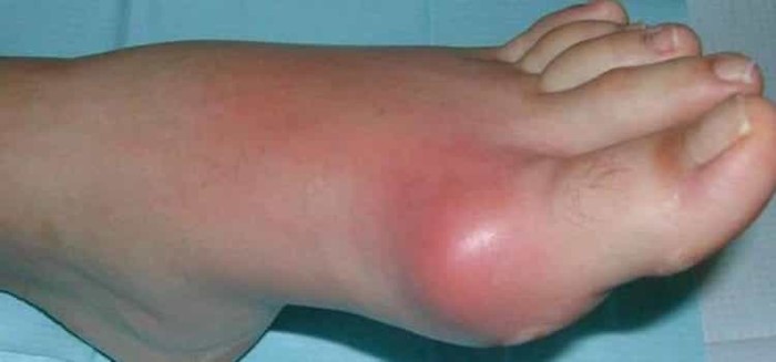 Подагра у женщин: симптомы, лечение и фото Подагра у женщин: симптомы, лечение и фото