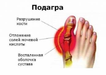 Подагра у женщин: симптомы, лечение и фото Подагра у женщин: симптомы, лечение и фото