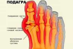 Подагра у женщин: симптомы, лечение и фото Подагра у женщин: симптомы, лечение и фото