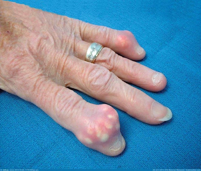 Подагра у женщин: симптомы, лечение и фото Подагра у женщин: симптомы, лечение и фото