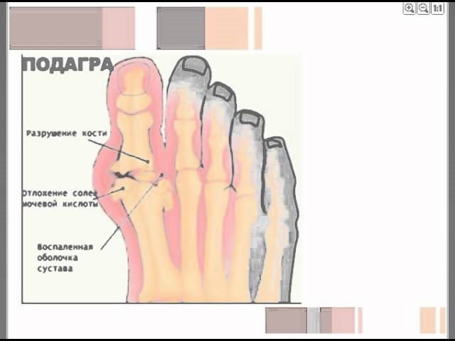 Что такое подагра: что это за болезнь, как выглядит и как лечить Что такое подагра: что это за болезнь, как выглядит и как лечить