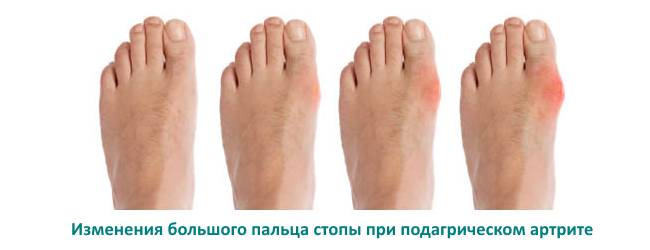 Анализы для диагностики при подагре Анализы для диагностики при подагре