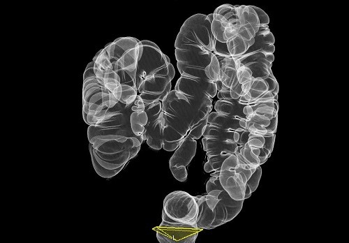 Диагностическая процедура колоноскопии кишечника Диагностическая процедура колоноскопии кишечника