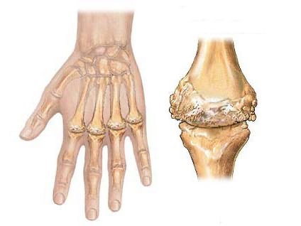 Что такое полиартрит: причины, признаки болезни (хронический, обменный, острый) Что такое полиартрит: причины, признаки болезни (хронический, обменный, острый)