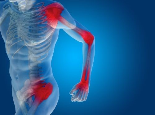 Что такое полиартрит: причины, признаки болезни (хронический, обменный, острый) Что такое полиартрит: причины, признаки болезни (хронический, обменный, острый)