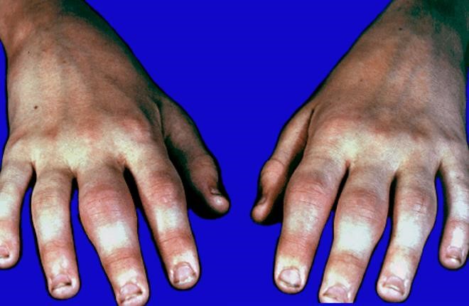 Полиартрит рук Полиартрит рук