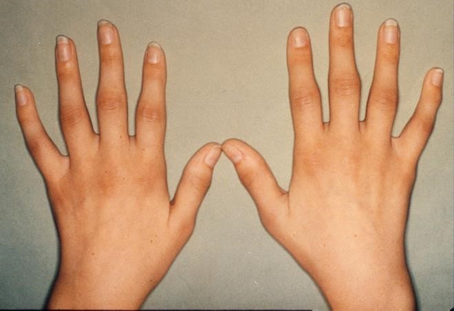 Полиартрит рук Полиартрит рук