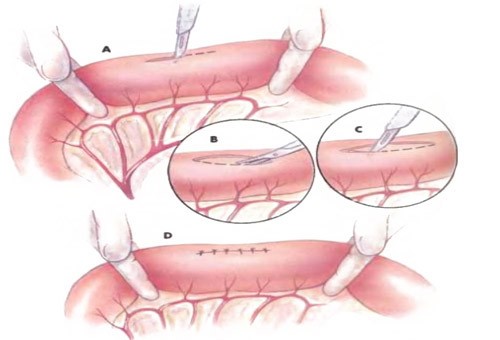 Какими методами удаляют полипы в кишечнике? Какими методами удаляют полипы в кишечнике?