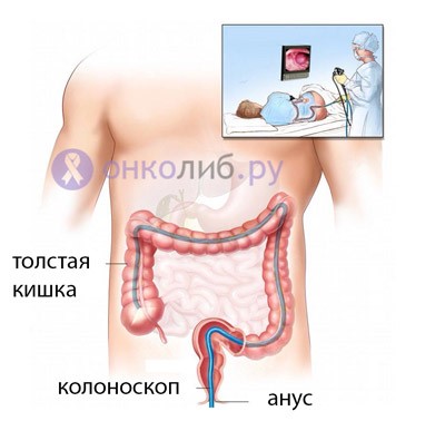 Какими методами удаляют полипы в кишечнике? Какими методами удаляют полипы в кишечнике?