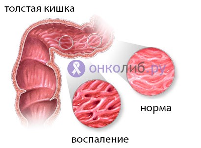 Какими методами удаляют полипы в кишечнике? Какими методами удаляют полипы в кишечнике?