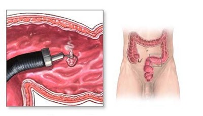 Какими методами удаляют полипы в кишечнике? Какими методами удаляют полипы в кишечнике?