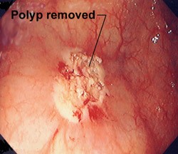 Какими методами удаляют полипы в кишечнике? Какими методами удаляют полипы в кишечнике?