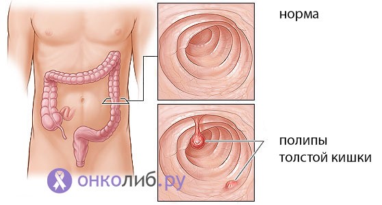 Какими методами удаляют полипы в кишечнике? Какими методами удаляют полипы в кишечнике?