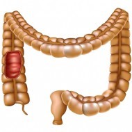 Какими методами удаляют полипы в кишечнике? Какими методами удаляют полипы в кишечнике?