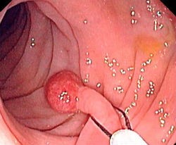 Как правильно лечить полипы в желудке Как правильно лечить полипы в желудке