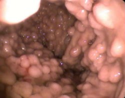 Как правильно лечить полипы в желудке Как правильно лечить полипы в желудке