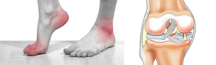 Как развивается и лечится посттравматический артроз голеностопного сустава? Как развивается и лечится посттравматический артроз голеностопного сустава?