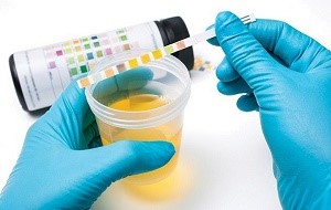 Белок в моче у мужчин — что это значит, какова его норма? Белок в моче у мужчин — что это значит, какова его норма?