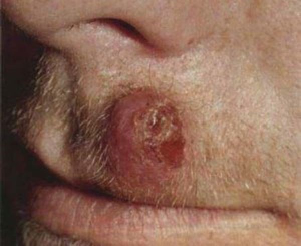 Причины и основные методы лечения фурункула в носу Причины и основные методы лечения фурункула в носу