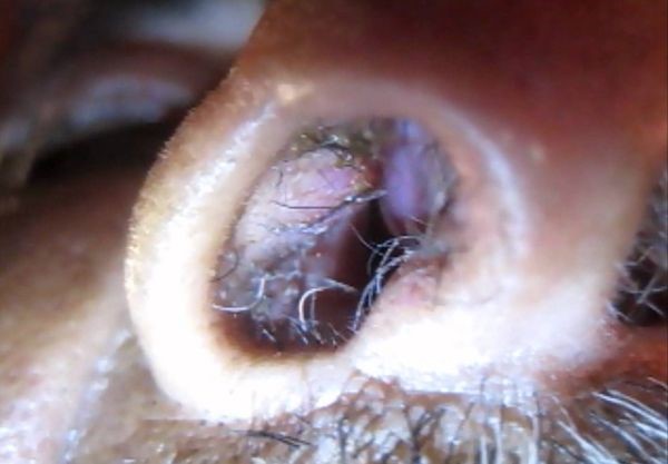 Причины и основные методы лечения фурункула в носу Причины и основные методы лечения фурункула в носу