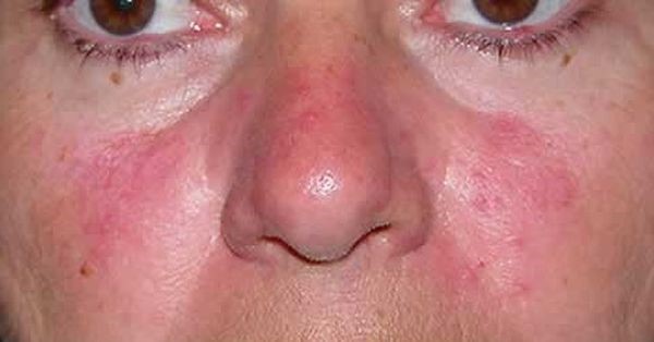 Причины и основные методы лечения фурункула в носу Причины и основные методы лечения фурункула в носу