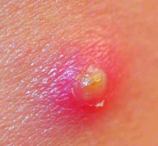 Причины и основные методы лечения фурункула в носу Причины и основные методы лечения фурункула в носу