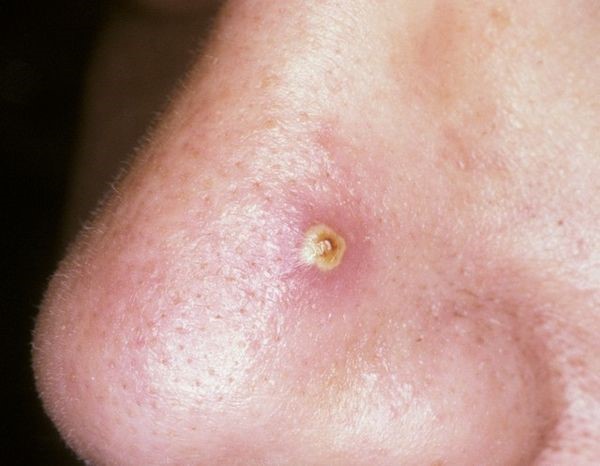 Причины и основные методы лечения фурункула в носу Причины и основные методы лечения фурункула в носу