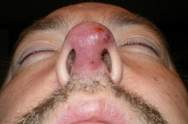 Причины и основные методы лечения фурункула в носу Причины и основные методы лечения фурункула в носу