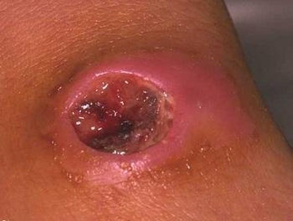 Причины и основные методы лечения фурункула в носу Причины и основные методы лечения фурункула в носу