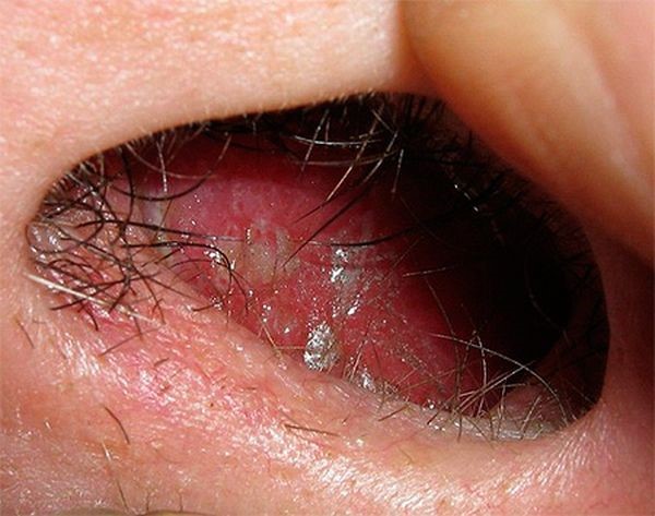 Причины и основные методы лечения фурункула в носу Причины и основные методы лечения фурункула в носу