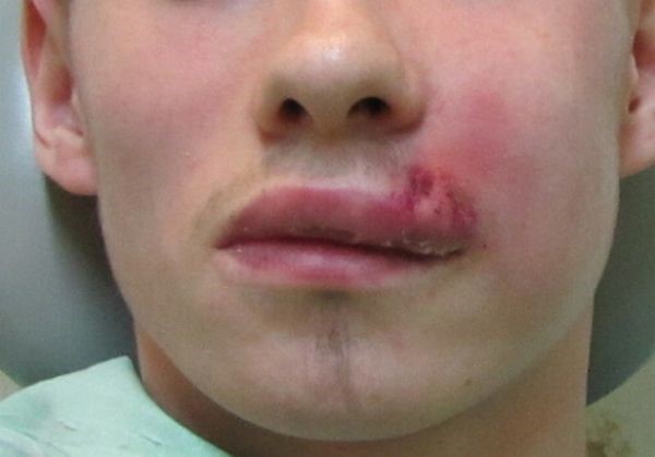 Причины и основные методы лечения фурункула в носу Причины и основные методы лечения фурункула в носу