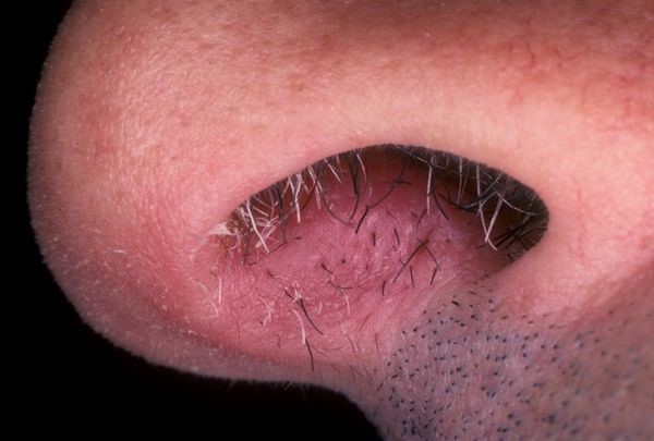 Причины и основные методы лечения фурункула в носу Причины и основные методы лечения фурункула в носу