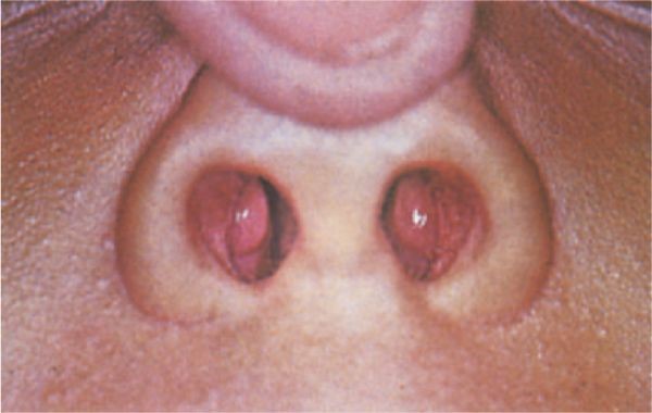 Причины и основные методы лечения фурункула в носу Причины и основные методы лечения фурункула в носу