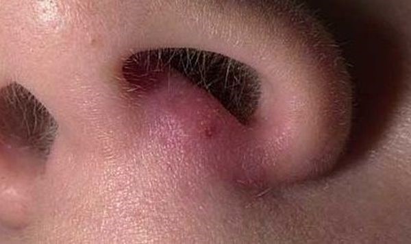 Причины и основные методы лечения фурункула в носу Причины и основные методы лечения фурункула в носу