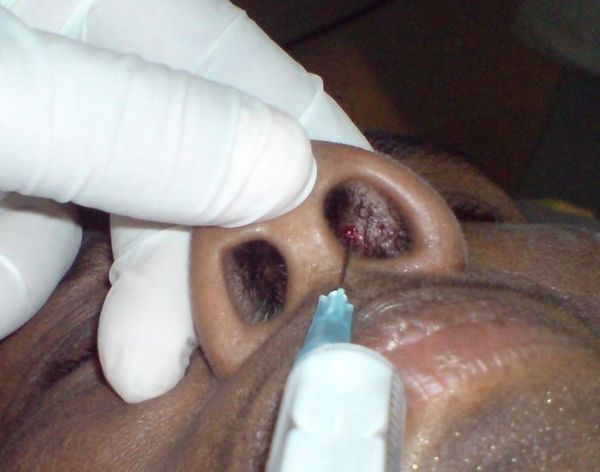 Причины и основные методы лечения фурункула в носу Причины и основные методы лечения фурункула в носу