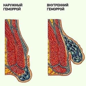 Внешний геморрой: как лечить данное заболевание, чем оно вызывается и какие у него симптомы Внешний геморрой: как лечить данное заболевание, чем оно вызывается и какие у него симптомы