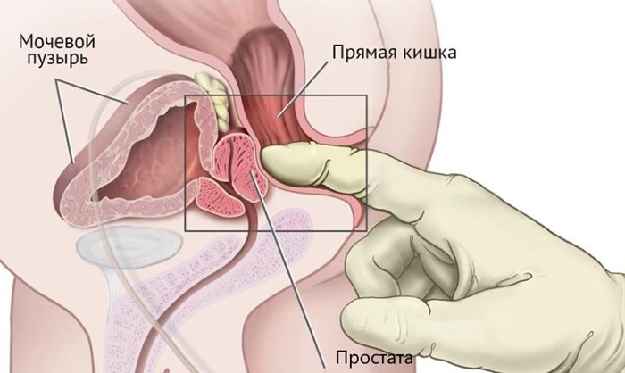 Внешний геморрой: как лечить данное заболевание, чем оно вызывается и какие у него симптомы Внешний геморрой: как лечить данное заболевание, чем оно вызывается и какие у него симптомы
