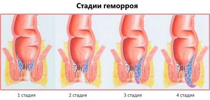 Внешний геморрой: как лечить данное заболевание, чем оно вызывается и какие у него симптомы Внешний геморрой: как лечить данное заболевание, чем оно вызывается и какие у него симптомы