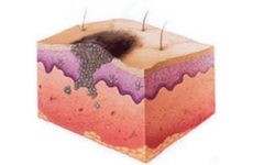 Причины, симптомы и лечение опухоли поджелудочной железы Причины, симптомы и лечение опухоли поджелудочной железы
