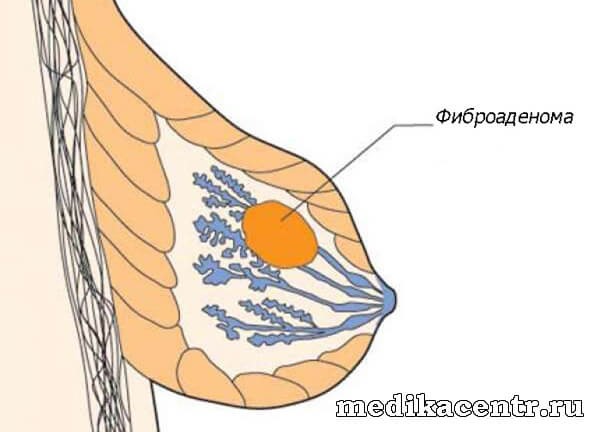 Причины и симптомы пневмонии у детей Причины и симптомы пневмонии у детей
