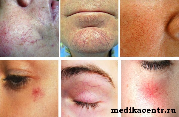 Причины и симптомы пневмонии у детей Причины и симптомы пневмонии у детей