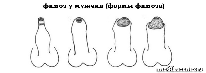 Причины и симптомы пневмонии у детей Причины и симптомы пневмонии у детей