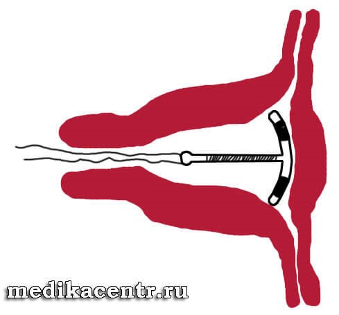 Причины и симптомы пневмонии у детей Причины и симптомы пневмонии у детей