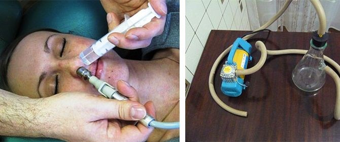 Лечение гайморита с помощью методики «Кукушка» Лечение гайморита с помощью методики «Кукушка»